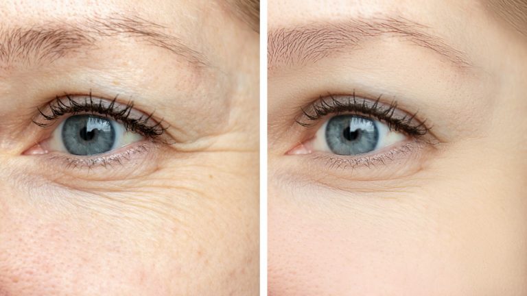 Anti Aging Treatments, Deep Wrinkles